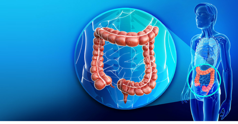 Polipi del colon, cosa sono?